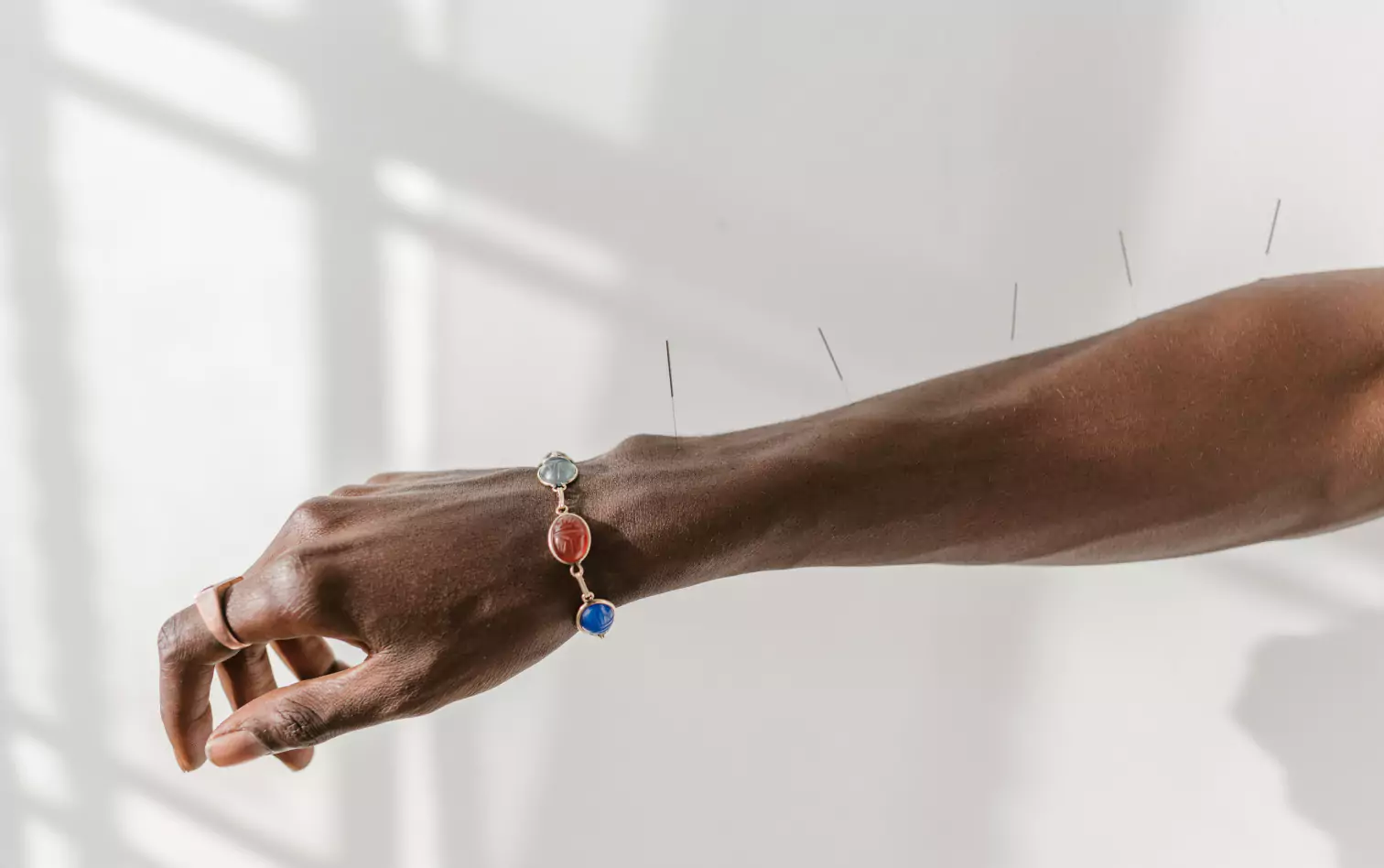 a person getting acupuncture treatment