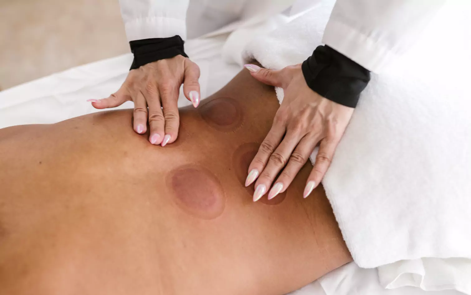 a person getting cupping therapy