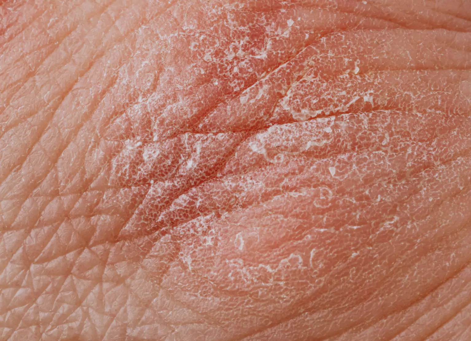 Close up of Caucasian skin with dermatomyositis