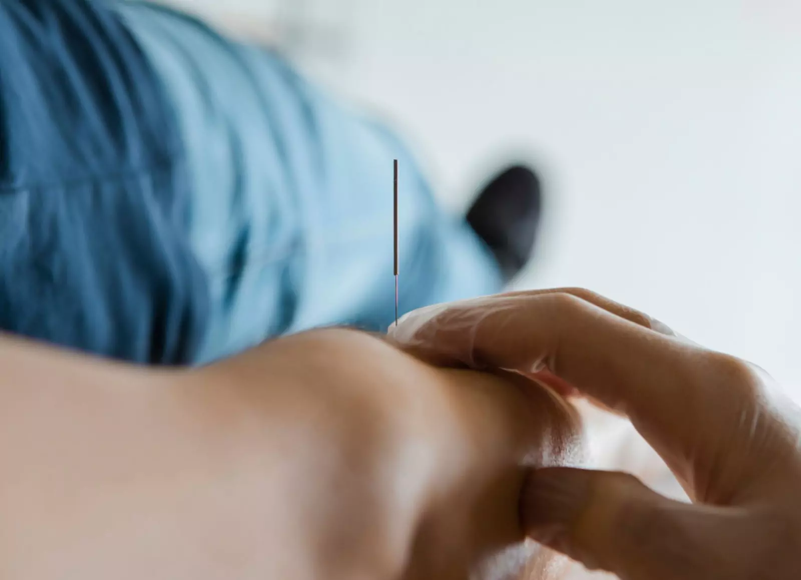 a person getting an acupuncture treatment on their arm