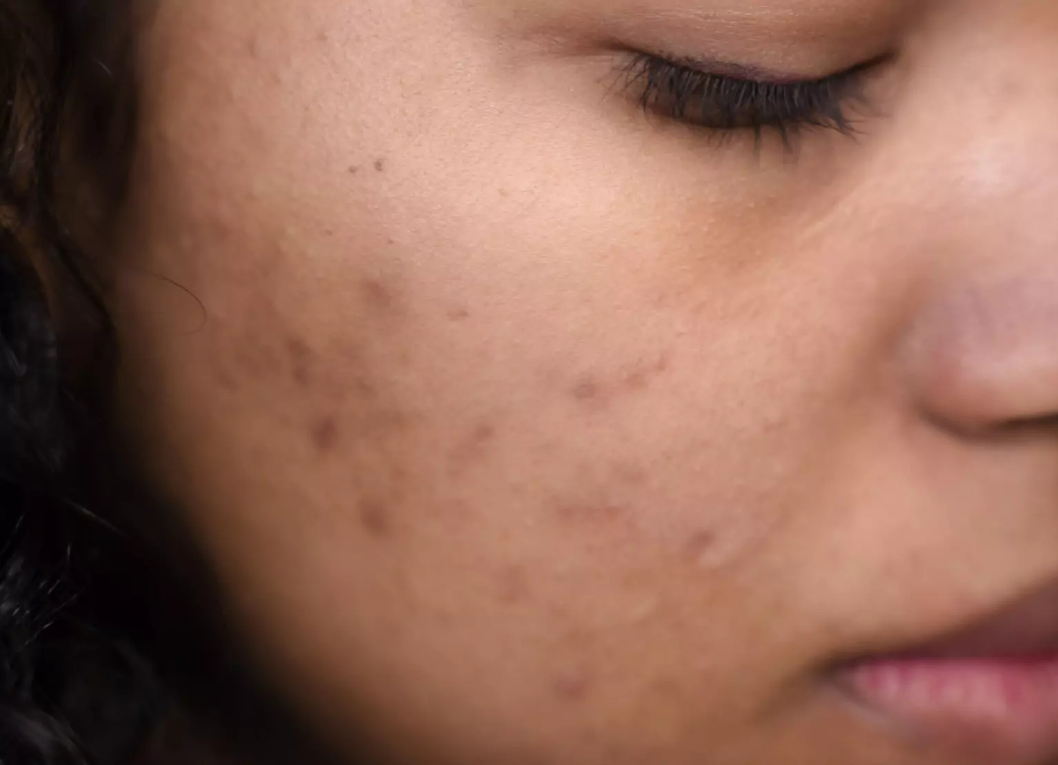 Can Too Much Skincare Cause Acne