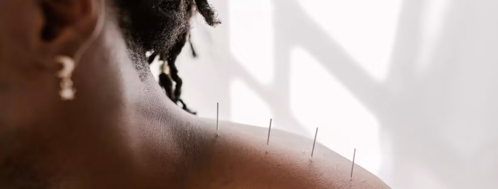 a person getting acupuncture treatment