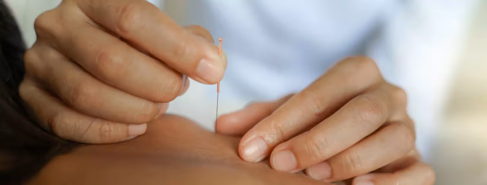 a person getting an acupuncture treatment on their back