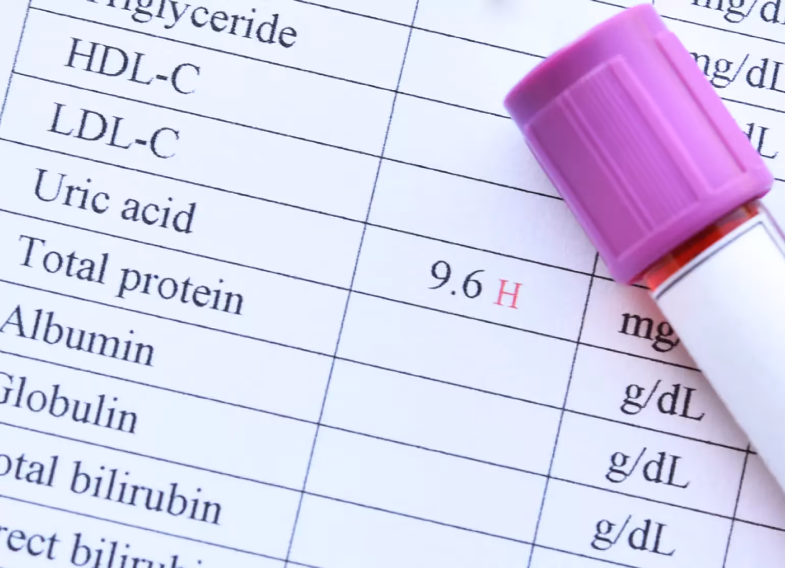 Lab test showing high uric acid levels