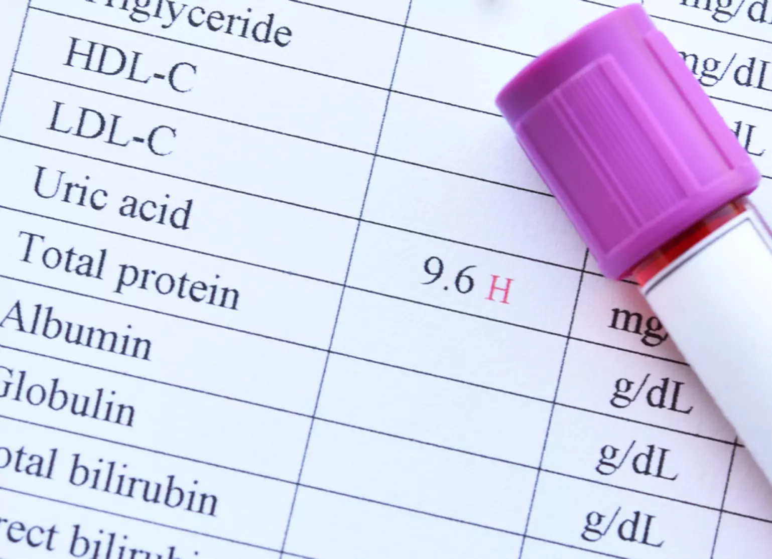 Lab test showing high uric acid levels